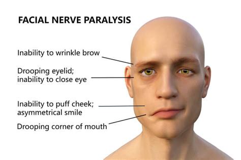 bell's palsy nhs patient leaflet